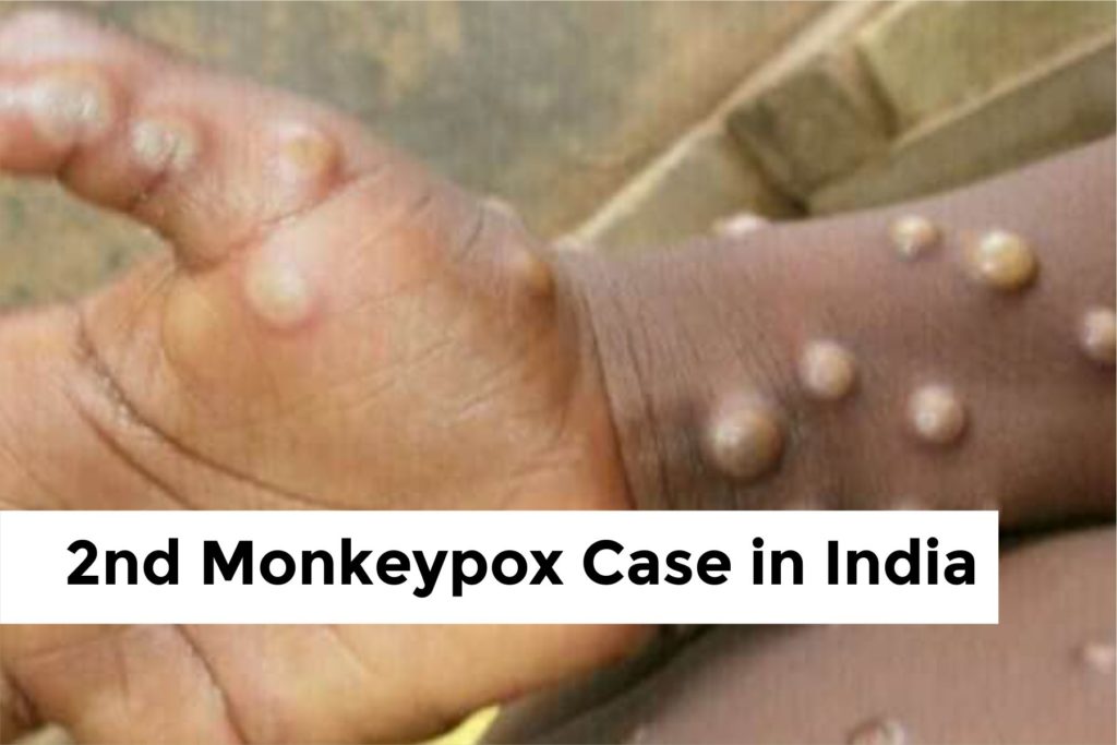 Second Monkeypox Case in india
