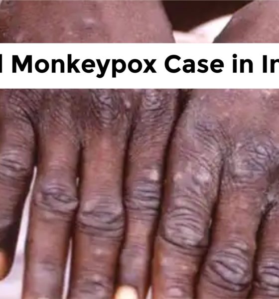 second case of monkeypox