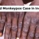 second case of monkeypox