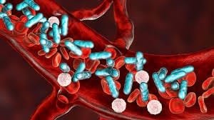 Understanding Sepsis: A Comprehensive Guide 95 sepsis