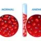 anaemia