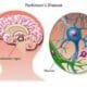 parkinson